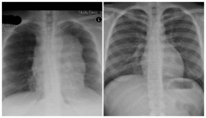 Left Junelle's Xray, Right Normal X-ray